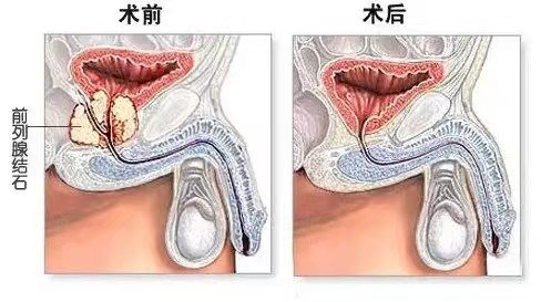 长春医科医院前列腺结石的发病原因是什么