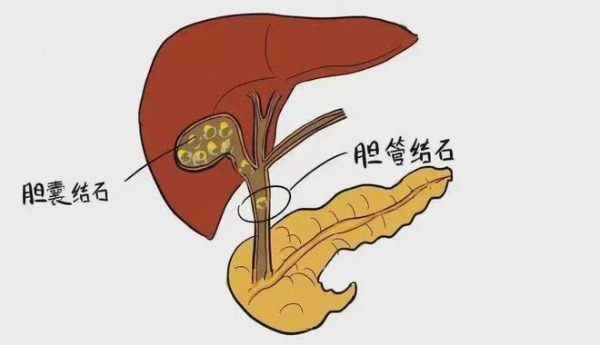 长春医科医院胆囊结石会引发哪些并发症