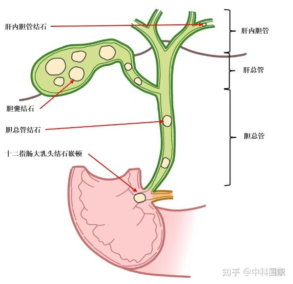 长春医科医院胆总管结石的成因有哪些