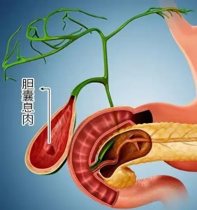 长春医科医院胆囊息肉的治疗方法有哪些