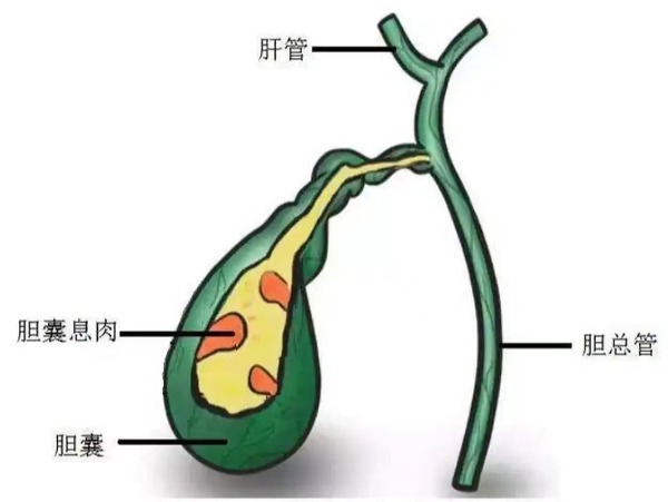 长春医科医院胆囊息肉有哪些症状