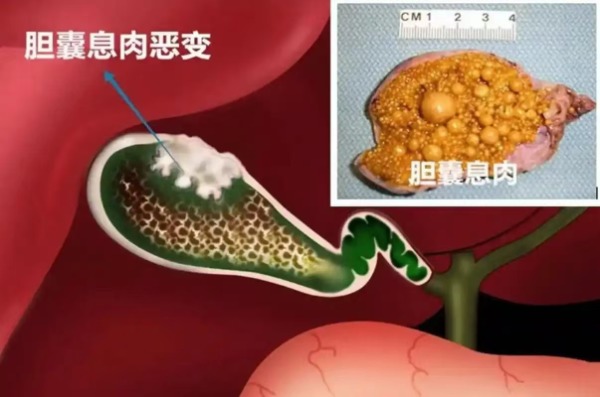 长春医科医院如何判断是否得了胆囊息肉