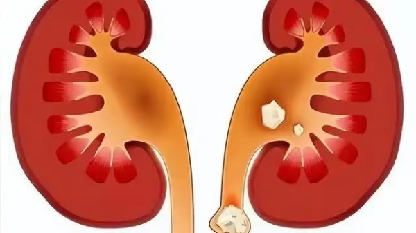 长春医科医院肾结石的形成原因有哪些