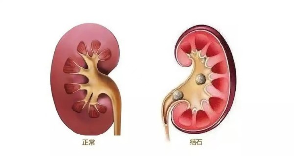 长春医科医院肾结石的治疗方法有哪些