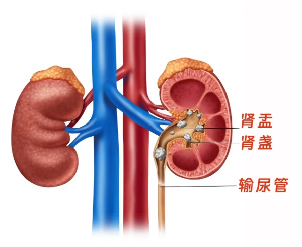 长春医科输尿管结石患者饮食上有哪些注意事项