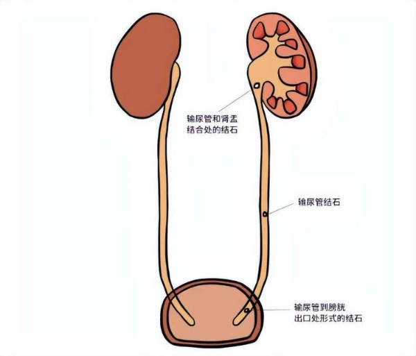 长春医科医院输尿管结石术后如何护理