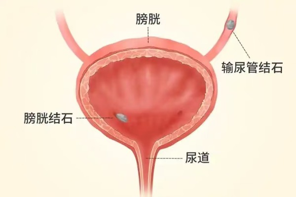 长春医科医院膀胱结石如何诊断