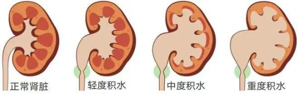 长春医科医院肾积水如何诊断