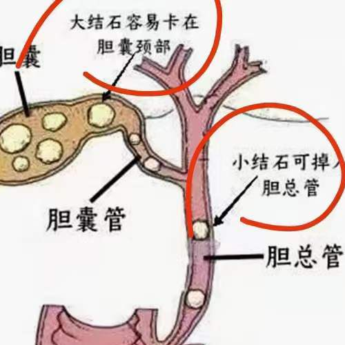 长春医科医院胆总管结石是什么