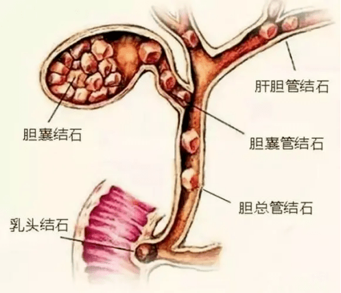 长春医科医院胆总管结石为何需要重视预防