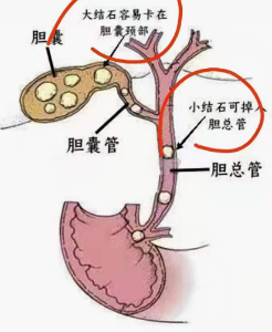 长春医科医院胆总管结石为何会引发胆道出血