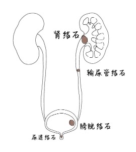 长春医科医院尿道结石如何预防