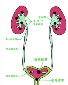 长春医科医院尿道结石为何偏爱男性