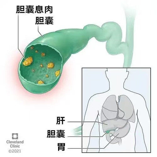 长春医科医院胆囊息肉胆囊里的不速之客从何而来