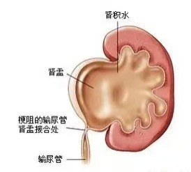 长春医科医院肾积水尿液的迷宫探险