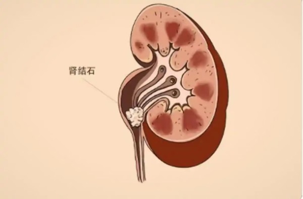 长春医科医院肾结石那些你不知道的食物陷阱