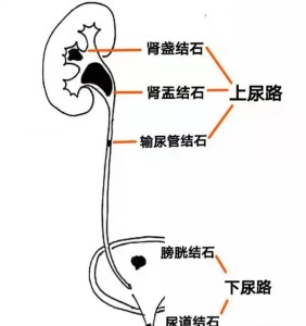 长春医科医院尿道结石你知道它的变形记吗