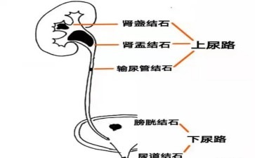 长春医科尿道结石它竟然和懒有关