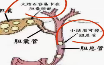 长春医科医院胆总管结石是胆汁的叛逆行为吗