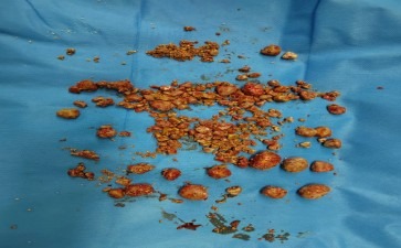 长春医科医院尿道结石那些与石头共舞的奇妙体验