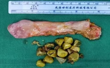 长春医科医院胆囊结石你的饮食习惯背锅了吗