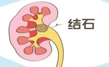 长春医科医院肾结石也会旅行吗
