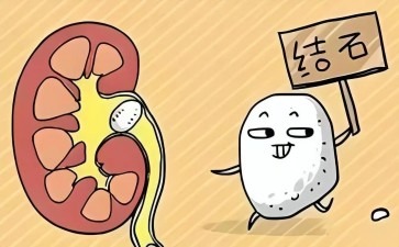 肾结石为何职业也与它有关