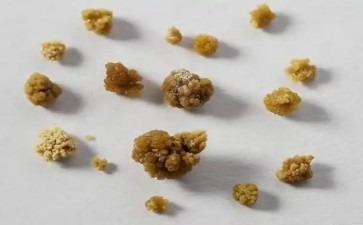 肾结石是运动不足的副产品吗