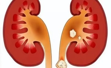 肾结石疼痛背后的隐形杀手