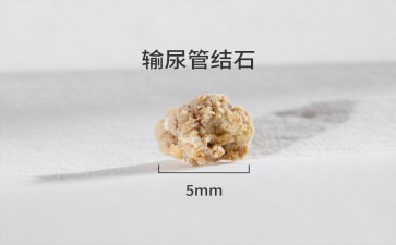 长春医科医院输尿管结石为何夏日更易找上门