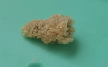 长春医科医院输尿管结石为何总让人坐立难安