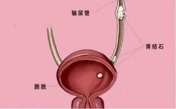 探秘胆囊结石症状成因与防治策略全解析