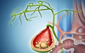 长春医科医院胆囊炎不可忽视的胆囊健康警钟
