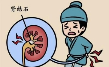 长春医科医院肾结石守护肾脏健康的隐形挑战