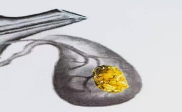 深入解析胆囊结石症状成因与预防策略