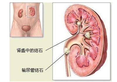 输尿管石界探秘解锁尿路健康的隐形挑战