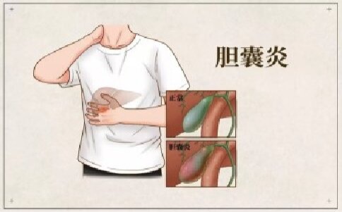 胆囊炎阵来袭健康防线莫失守