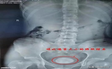 膀胱石困来扰健康警钟需长敲