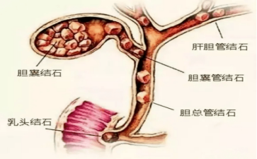 胆总管结石暗礁阻航健康通道亟待清障