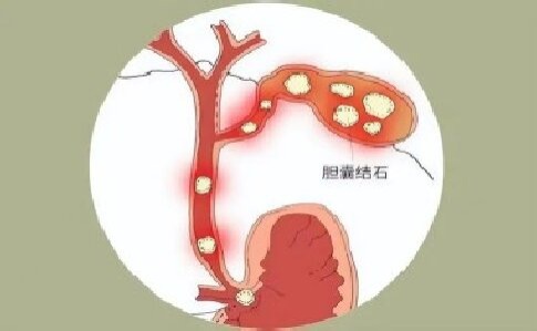 胆囊结石兴风浪开启剿石欢乐大闯荡