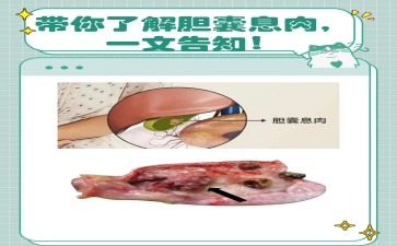胆囊息肉搞小动作开启擒息欢乐大行动