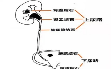 尿道结石尿道里的拦路小顽石搞事情啦