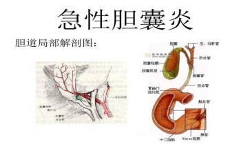 胆囊炎胆囊里燃起的小火苗在捣乱啦