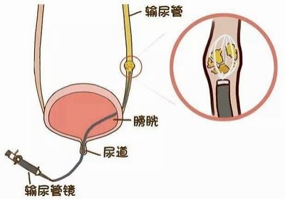 输尿管结石输尿管里的疯狂小石子大闹剧