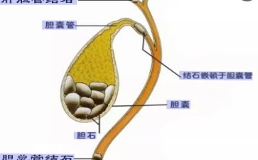 胆战石惊大冒险胆囊结石的奇妙之旅