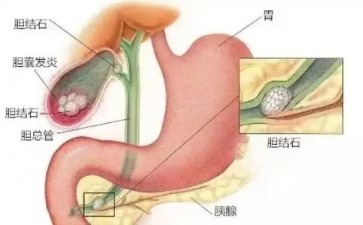 胆囊里砌小石墙是身体在搞建筑吗