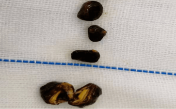 胆总管里藏小石子是身体在埋隐患吗
