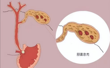 胆囊里冒出小肉疙瘩是福是祸