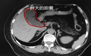 胆囊里燃起小火焰会怎样