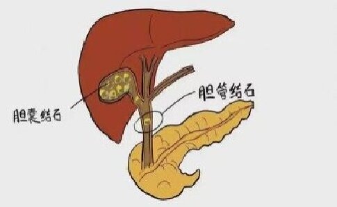 胆囊里长出小宝石是喜是忧